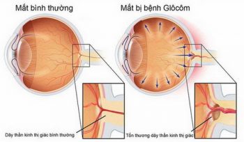 Hình ảnh mắt bị glaucoma.